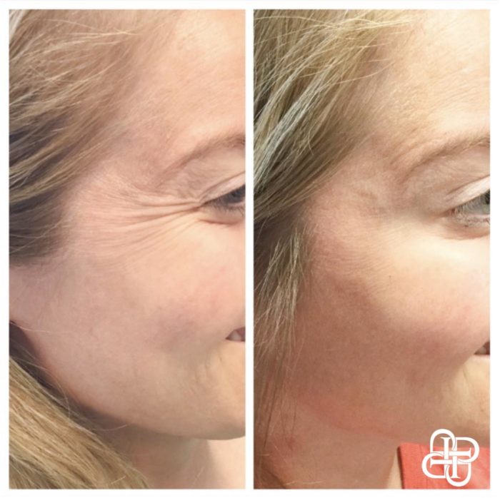 Privé Med Spa Lexington KY, Before & After of Botox Crows Feet • Privé