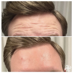 Lexington KY, Before & After of Botox for Forehead for Men