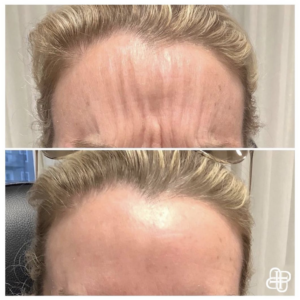 Lexington KY, Before & After of Botox on Forehead