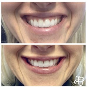 Lexington KY, Before & After of Botox for a Gummy Smile