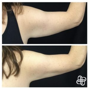 Lexington KY, Before & After of CoolSculpting for Arms