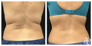 Lexington KY, Before & After of CoolSculpting for Back