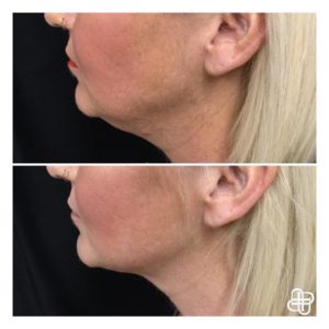 Lexington KY, Before & After of CoolSculpting for Chin
