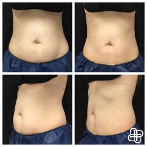 Lexington KY, Before & After of CoolSculpting on Stomach