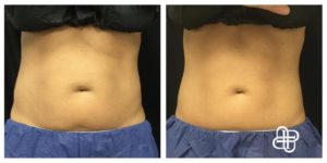 Lexington KY, Before & After of CoolSculpting for Stomach