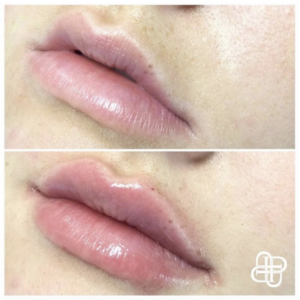 Lexington KY, Before & After of Dermal Filler for Lips