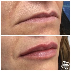Lower Face Lip Filler Before & After