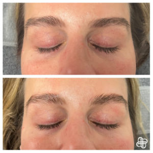 Lexington KY, Before & After of Eyebrows Treatment