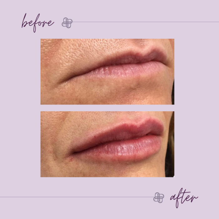 Dermal Fillers • Privé Med Spa, Lexington KY • 859.523.5893